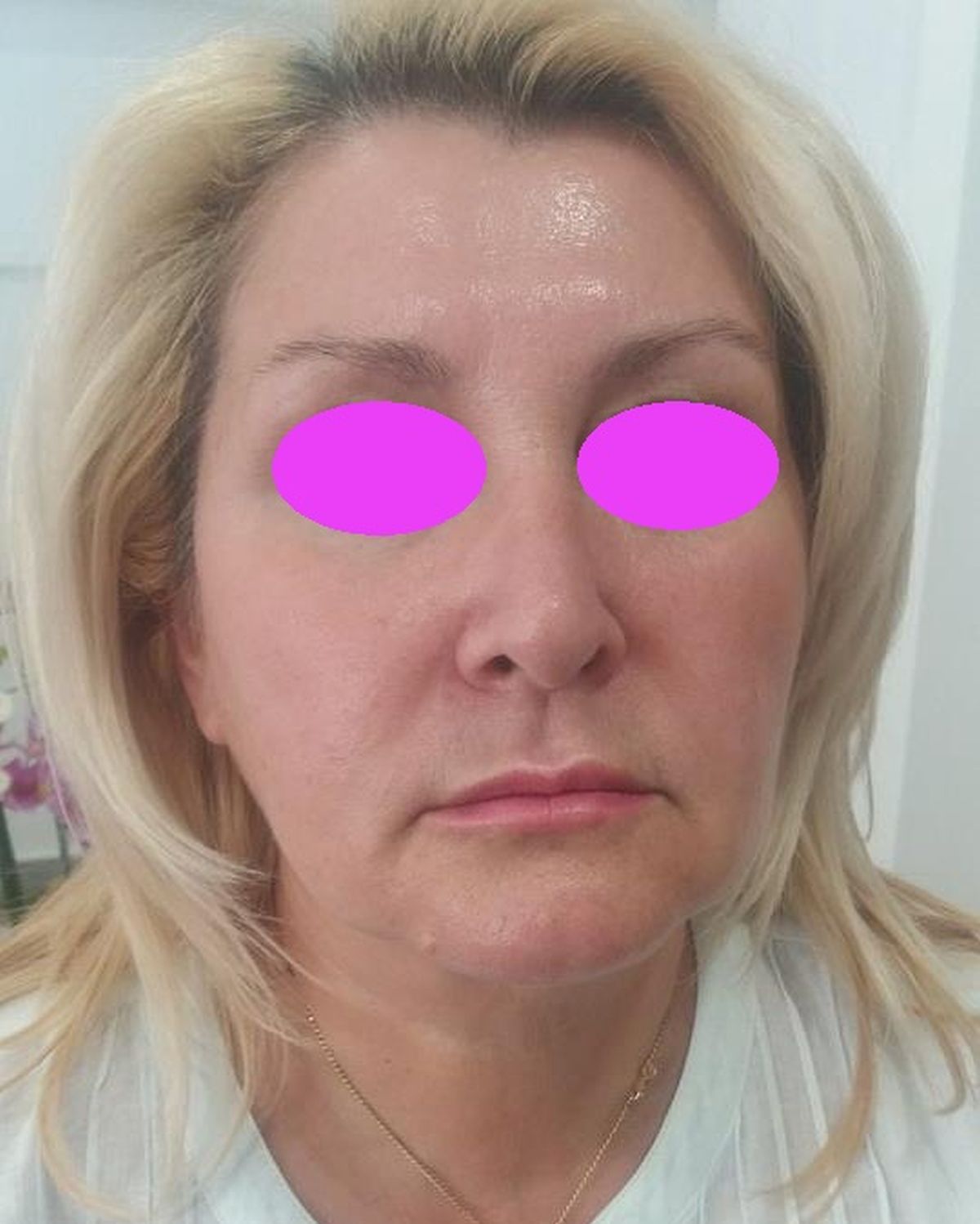 Botox